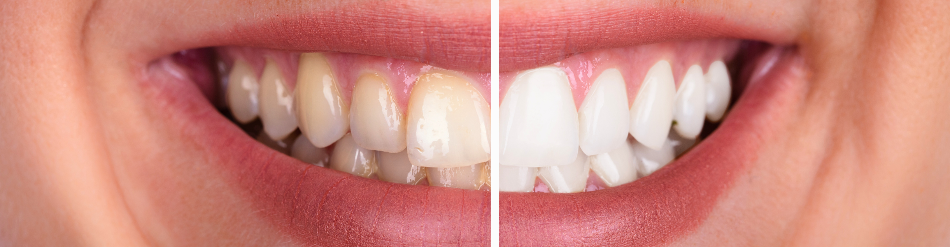Side by side photo of woman's smile before and after whitening.